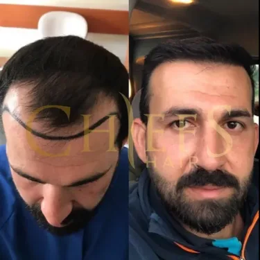 Hair transplantation