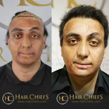 Hair transplantation