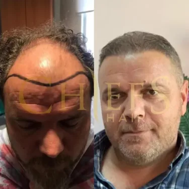 Hair transplantation