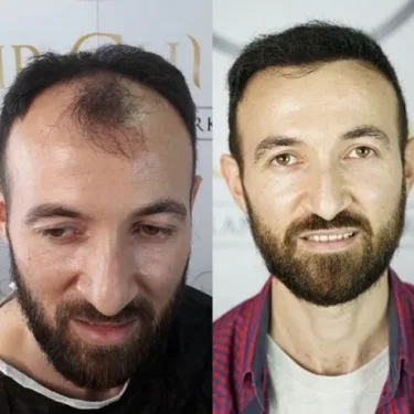 Hair transplantation