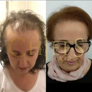 Hair transplantation