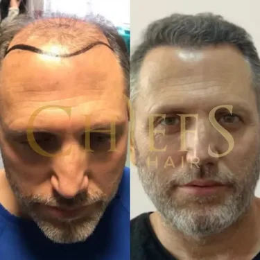 Hair transplantation