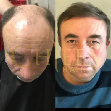 Hair transplantation