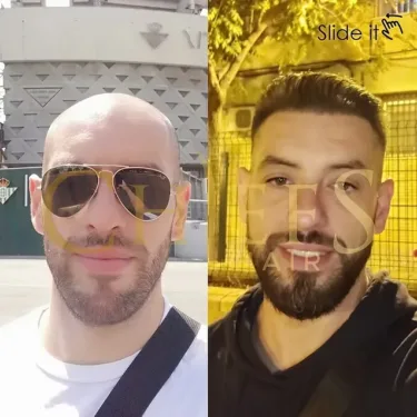 Hair transplantation