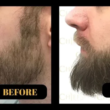 Beard transplant 