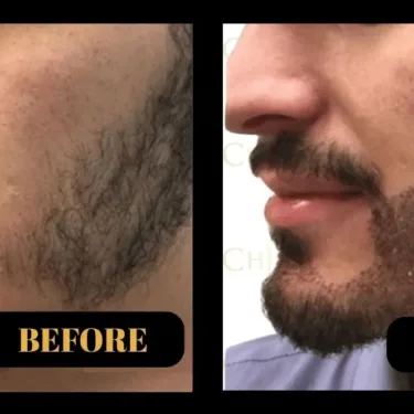Beard transplant 