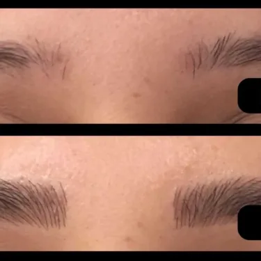 Eyebrow transplant