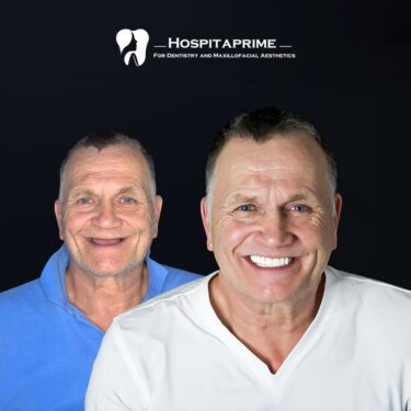 Zygomatic zygomatic dental implants