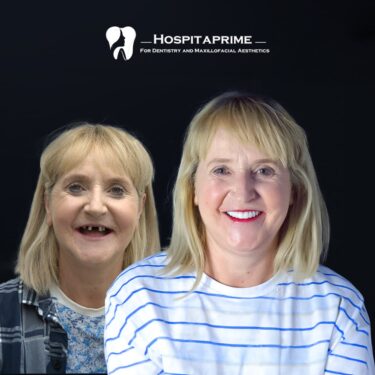 Zygomatic zygomatic dental implants