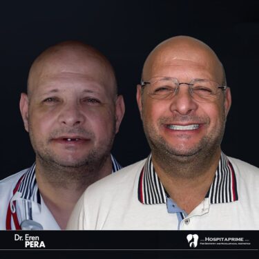 Zygomatic zygomatic dental implants