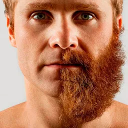 Beard transplant
