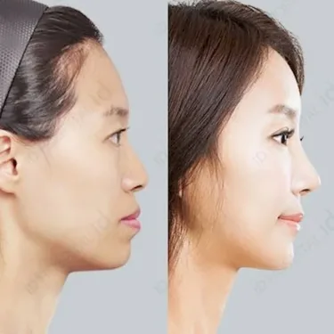 Rhinoplasty