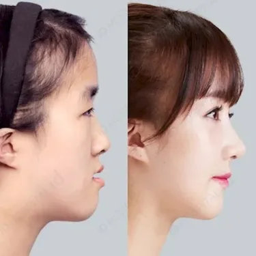 Rhinoplasty