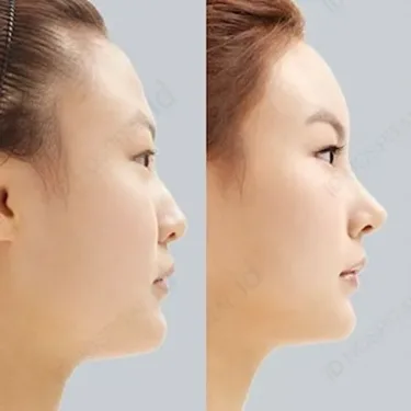 Rhinoplasty