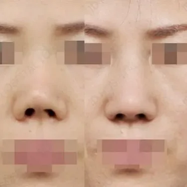 Rhinoplasty