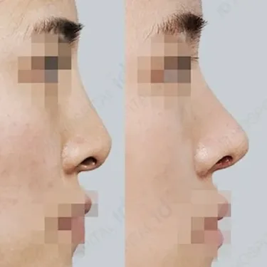 Rhinoplasty