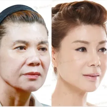 Подтяжка лица