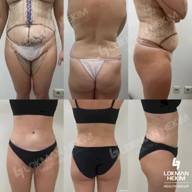 Липосакция 360