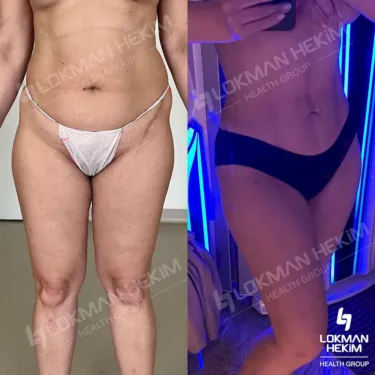 Липосакция 360