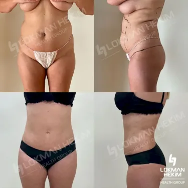 Липосакция 360