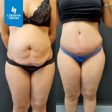 Абдоминопластика