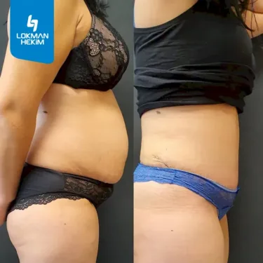 Абдоминопластика