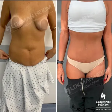 Абдоминопластика