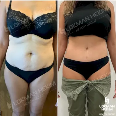 Абдоминопластика