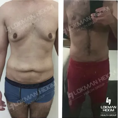 Абдоминопластика