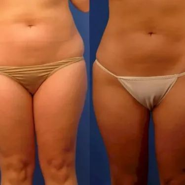 Липосакция