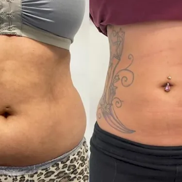 Липосакция