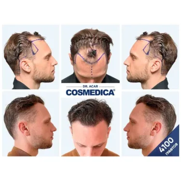 Hair transplant