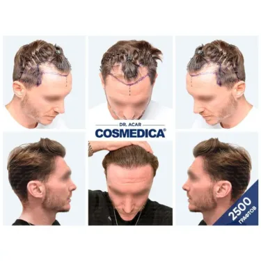 Hair transplant