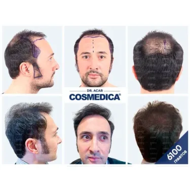 Hair transplant