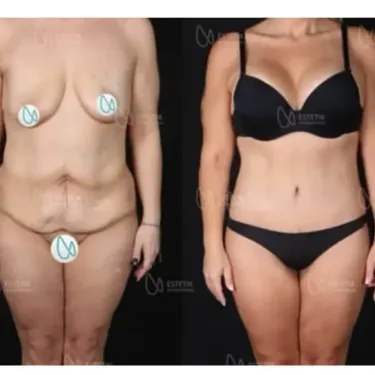 Липосакция