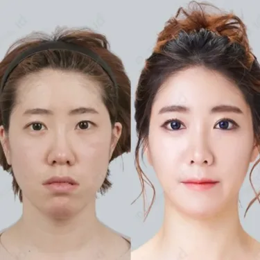 Face contouring