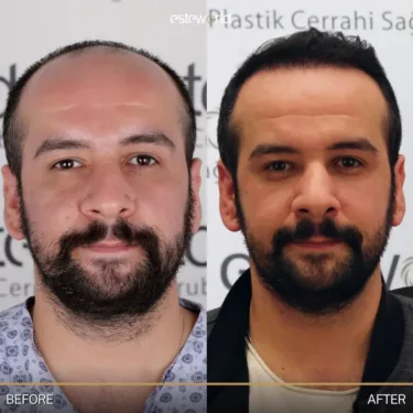 Hair transplantation