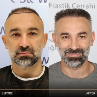 Hair transplantation
