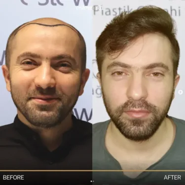 Hair transplantation