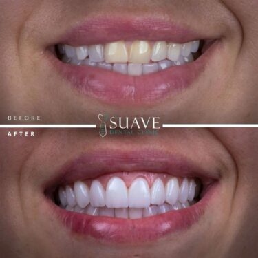 Veneers installation