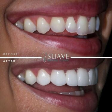 Veneers installation