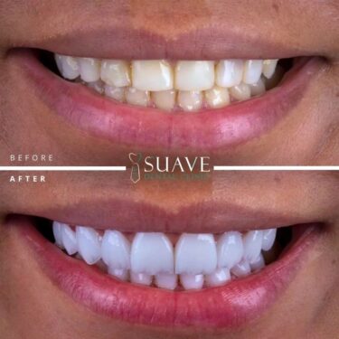Veneers installation