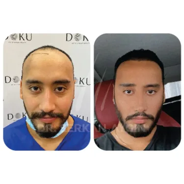 Hair Transplant