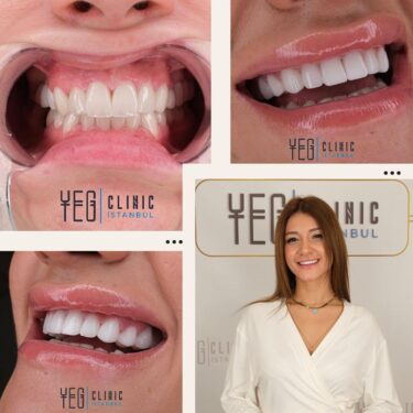Hollywood smile