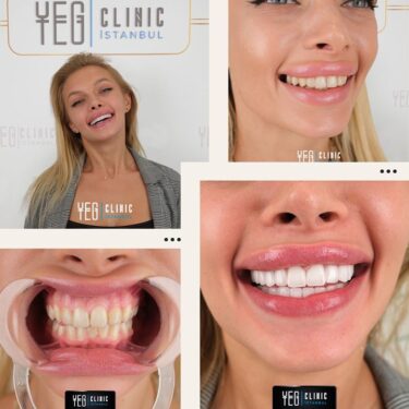 Hollywood smile