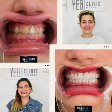 Hollywood smile