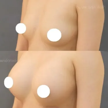 Маммопластика