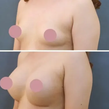 Маммопластика