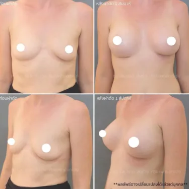 Маммопластика