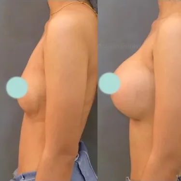 Маммопластика